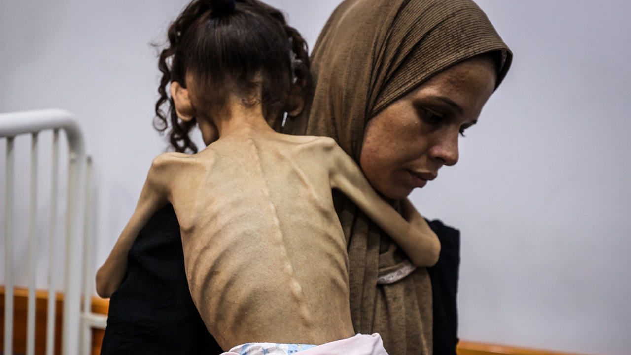 25 kilodan 10 kiloya düştü! Gazzeli Meryem'in son haline yürek dayanmıyor