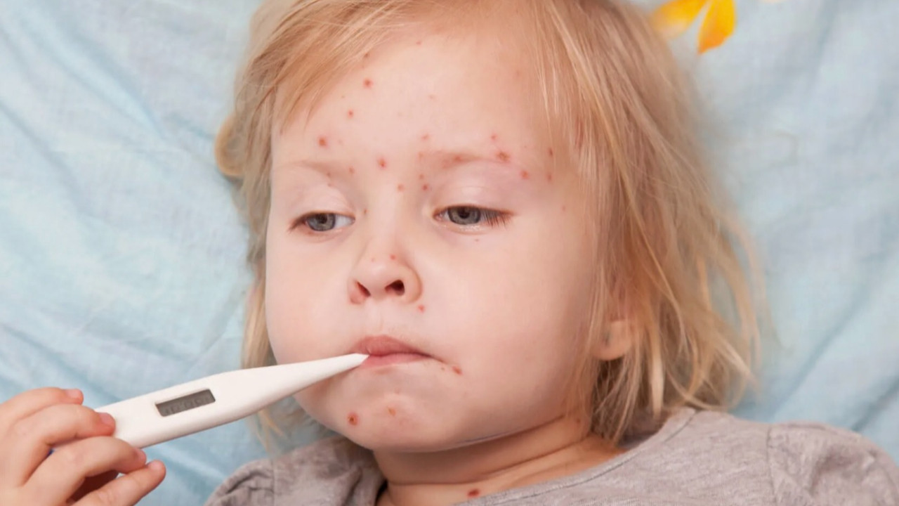 Su çiçeği vakaları artıyor! Uzmanlardan su çiçeği uyarıyor! Salgın riski var mı?