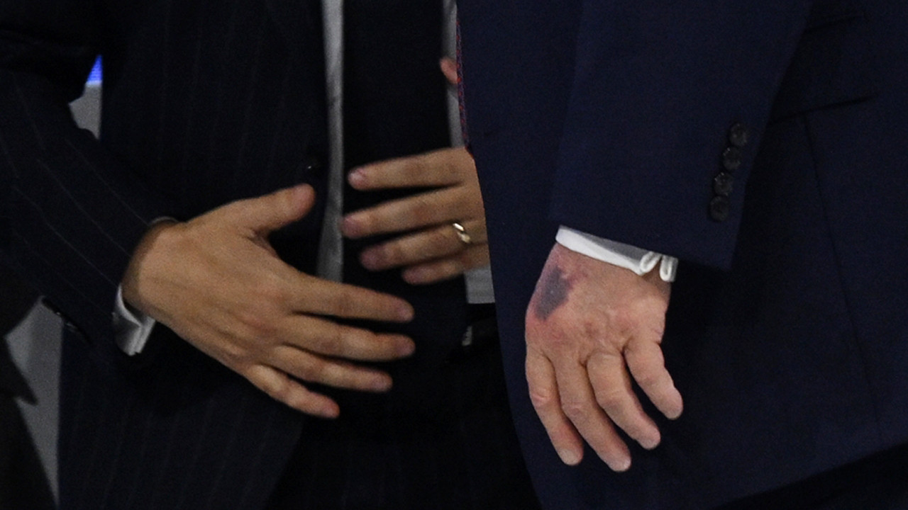 ABD Başkanı Trump, elindeki morluğun nedenini açıkladı