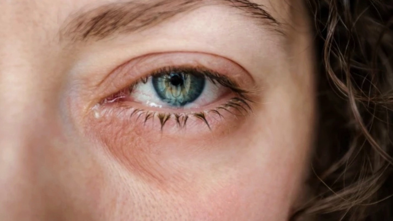 Gözde kaşıntıya dikkat! Bu hastalığın belirtisi olabilir...