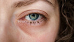 Gözde kaşıntıya dikkat! Bu hastalığın belirtisi olabilir...