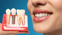 Diş tedavisinde yeni dönem: İmplant SSK kapsamına giriyor