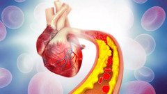 Kalp sağlığınız tehlike altında! Kötü kolestrol tetikliyor...