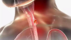 Yemek borusu kanserlerinde erken teşhisin önemi! Tedaviyi kolaylaştırıyor...