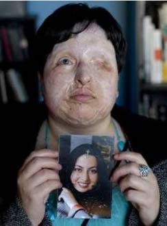 Yüzüne kezzap atıldı - Resim: 2