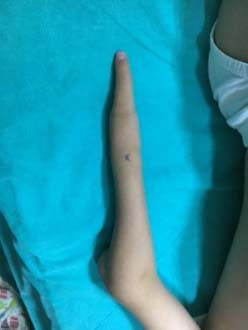 İki elinde sadece bir parmak vardı mucize ameliyat - Resim: 2