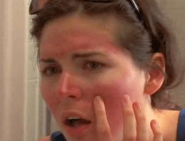 Güneş yanığı tedavisi için basit uygulamalar - Resim: 1