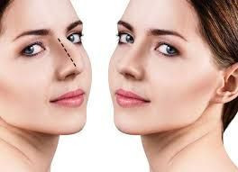 Uzmanı açıkladı! Estetik burun ameliyatı yaşam kalitesini arttırıyor - Resim: 3