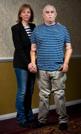 Dişçide iğne oldu kollarını ve bacağını kaybetti! - Resim: 3