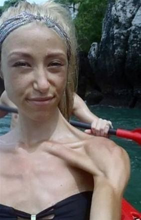 Anoreksiyadan kurtulan genç kızın mucizevi değişimi - Resim: 3