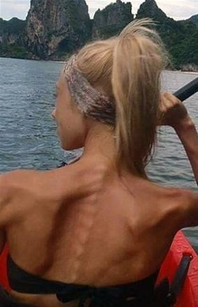 Anoreksiyadan kurtulan genç kızın mucizevi değişimi - Resim: 2