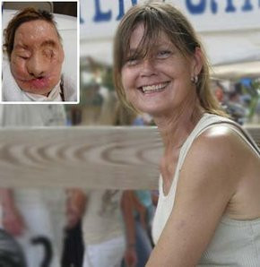 Şempanzenin parçaladığı kadına tam yüz nakli - Resim: 1