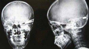 Yok artık diyeceğiniz röntgenler! - Resim: 2