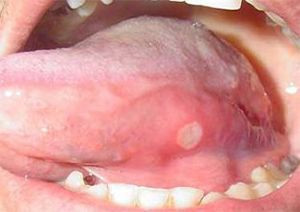 Dilde kabarcıklar neden olur? Nasıl geçer? - Resim: 4