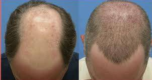 Bu ünlüler aslında kel - Resim: 1