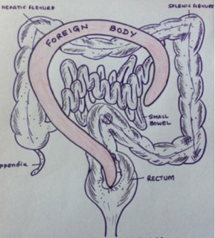Akıllara durgunluk veren olay sarhoş adamın anüsünden bu çıktı - Resim: 3