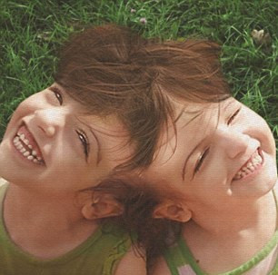 Kafadan yapışık ikizler herkesi şaşırtıyor - Resim: 2