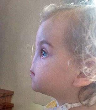 Burnu olmadan doğan bebek - Resim: 2