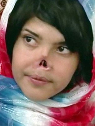 Burnu kesilen Afgan kızı artık gülüyor - Resim: 4