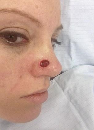 Yüzündekini sivilce sandı tümör çıktı - Resim: 4