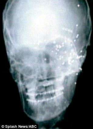 Yüzsüz kadına protez maske - Resim: 1