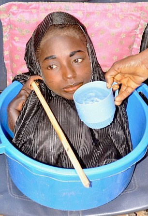 19'una kadar bedeni olmadan leğende yaşadı inanılmaz - Resim: 3