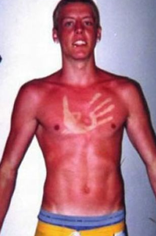 Güneşte yanma olayını abartınca... - Resim: 1