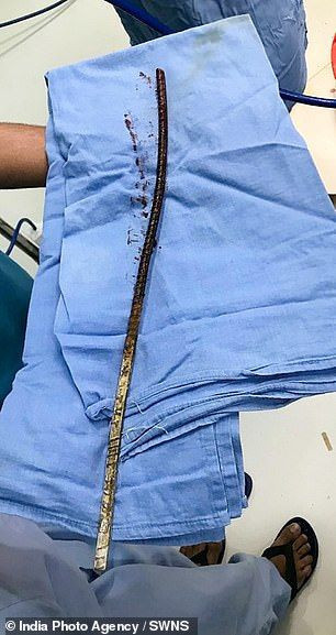 İşçinin başına demir saplandı! Doktorlar onu sağ görünce şaşırdı - Resim: 3