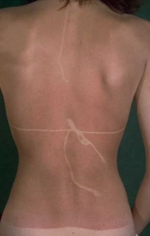 Güneşte yanma olayını abartınca... - Resim: 4