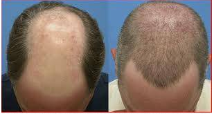 Aslında bu ünlülerin hepsi kel - Resim: 2