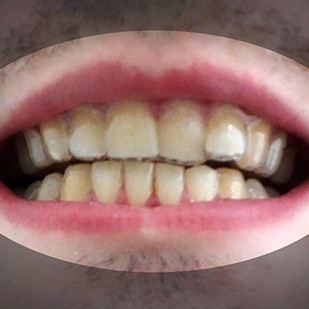 3D yazıcı ile dişlerini düzeltti - Resim: 2