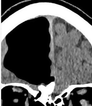 Baş ağrısı diye hasteneye gitti beyinsiz çıktı! - Resim: 2