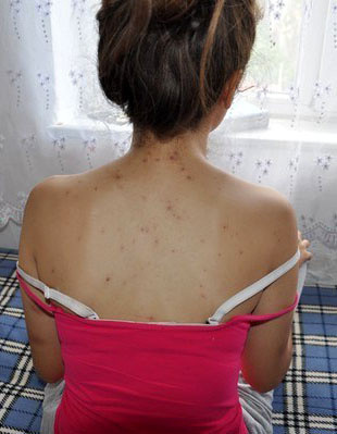 Çanakkale'de 17 yaşındaki Hilal Yavaş kız evine giderken arıların saldırısına uğradı! - Resim: 0