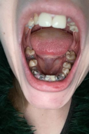 Ağrı kesici bu hale getirdi! 23 yaşındaki kadının tüm dişleri çürüyüp döküldü! - Resim: 2