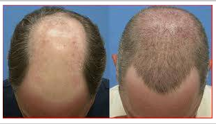 Aslında bu ünlülerin hepsi kel - Resim: 1