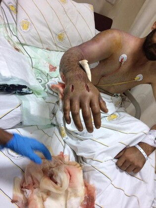 Yaraladığı yılan geri dönüp soktu - Resim: 1