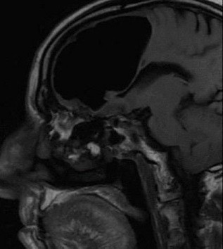 Baş ağrısı diye hasteneye gitti beyinsiz çıktı! - Resim: 1