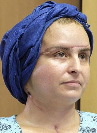 Yüz nakli sonrası inanılmaz değişim! Yok artık diyeceksiniz - Resim: 4