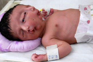 Dünyayı şok eden iki yüzlü bebek - Resim: 4