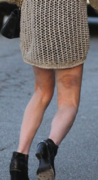 Ünlü güzelin her tarafı mosmor!  - Resim: 1