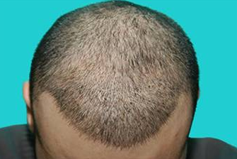 Bu ünlüler aslında kel - Resim: 3