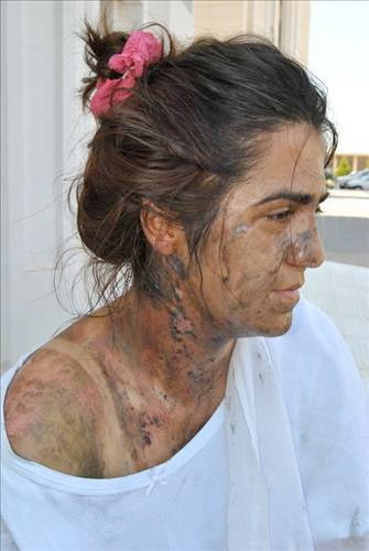 Kocası yüzüne asit döktü - Resim: 1