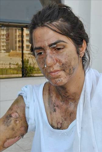Kocası yüzüne asit döktü - Resim: 3