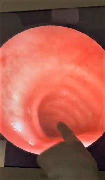 Nefes borusundan akciğere indi! Doktora başvuran hemşire şokta: Vücudundan çıktı! - Resim: 3