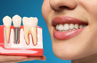 Diş tedavisinde yeni dönem: İmplant SSK kapsamına giriyor