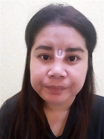 Estetik yaptırayım dedi sonu ise büyük facia! - Resim: 1