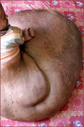 Bacağında 90 kiloluk tümör taşıyor - Resim: 3