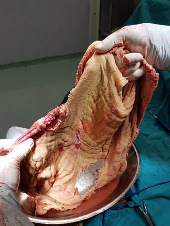 Karnından çıktı tam 1,8 kilo! Yeni bir gelişme yaşandı - Resim: 4