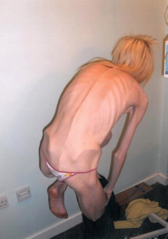 Anoreksiya'dan ölmek üzereydi! Mucizevi değişim herkesi şaşırttı - Resim: 1