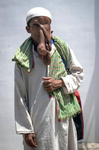 Fil adam ameliyatı reddetti - Resim: 2